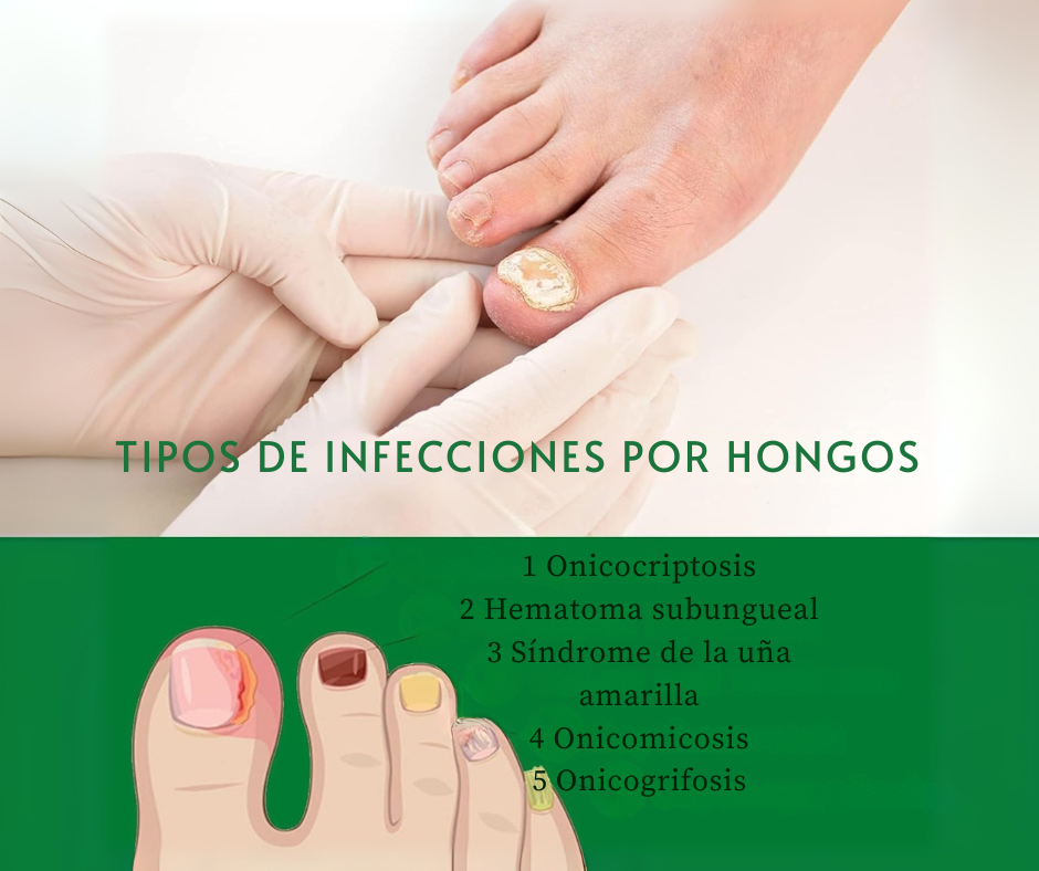 Gotas 7 días antihongos para pies™