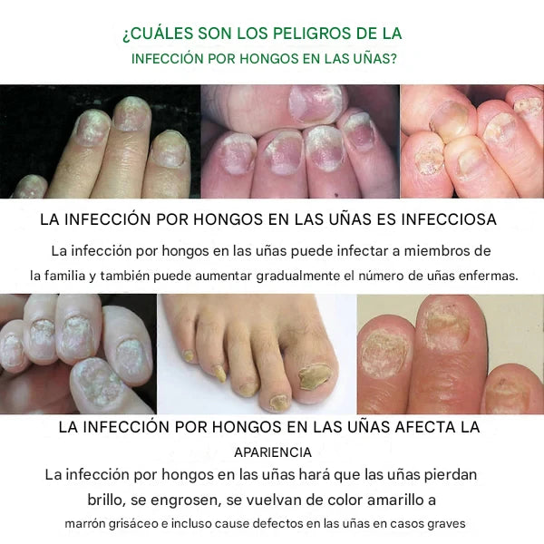 Gotas 7 días antihongos para pies™