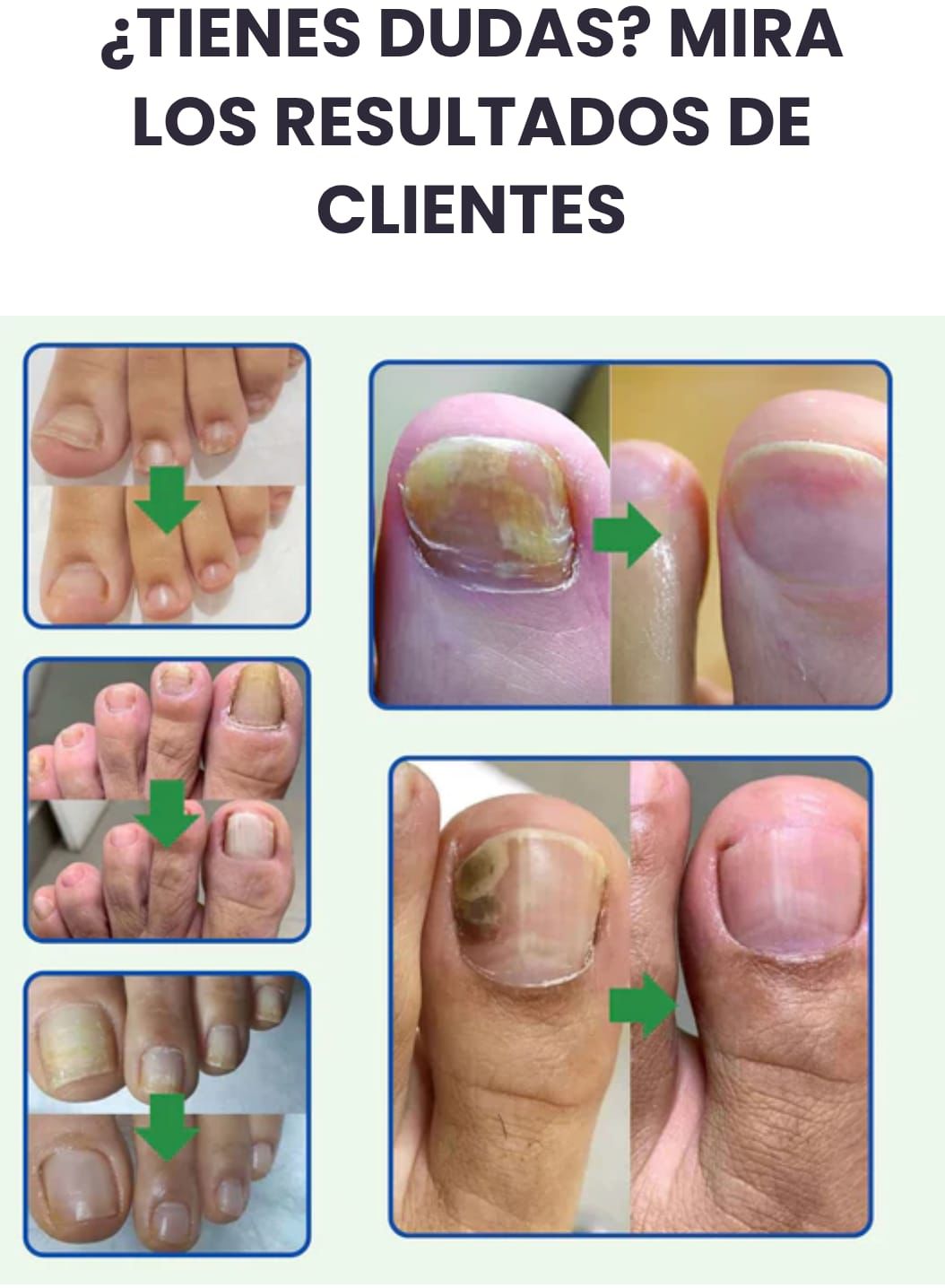 Gotas 7 días antihongos para pies™